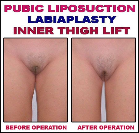 bad plastic surgery results