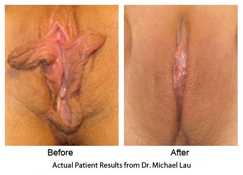 penis enlargement plastic surgery