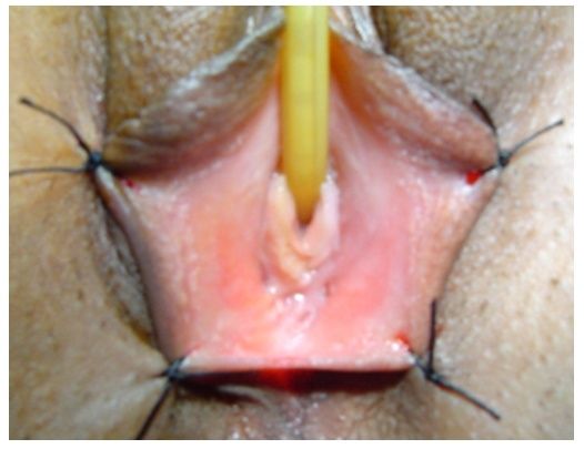 ciri vagina perawan