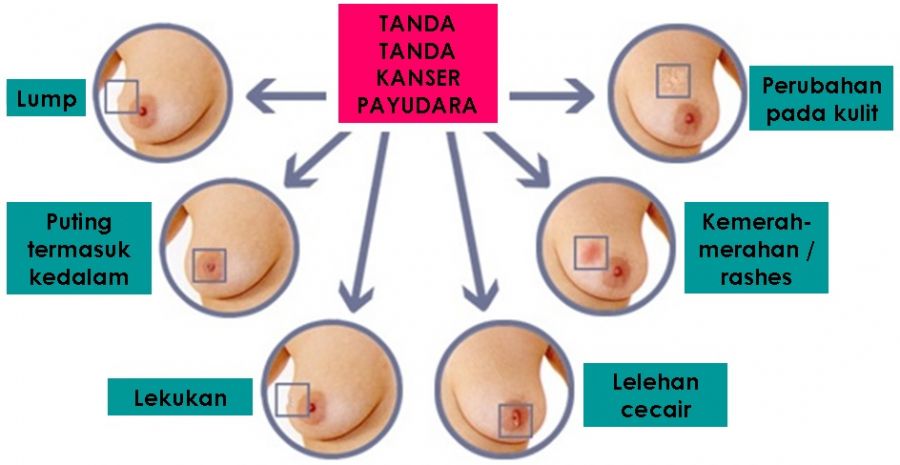 ciri kanker payudara