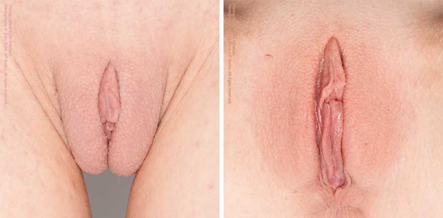 bentuk vagina yang melahirkan normal