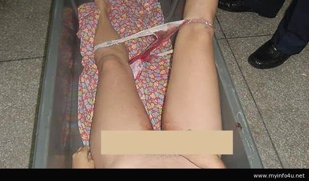 bentuk vagina yang melahirkan normal