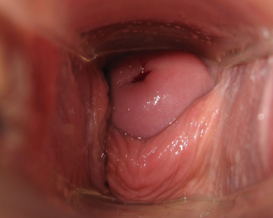 accidental ejaculation
