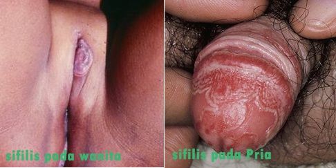 kelentit wanita